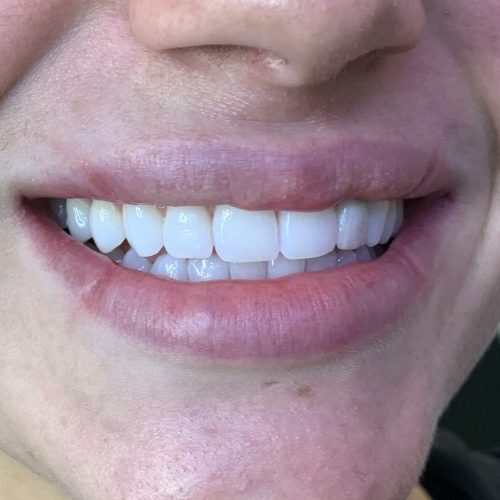 teeth-whitening-gold-coast-2